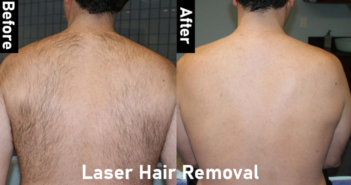Best Laser Hair Removal Treatment Service