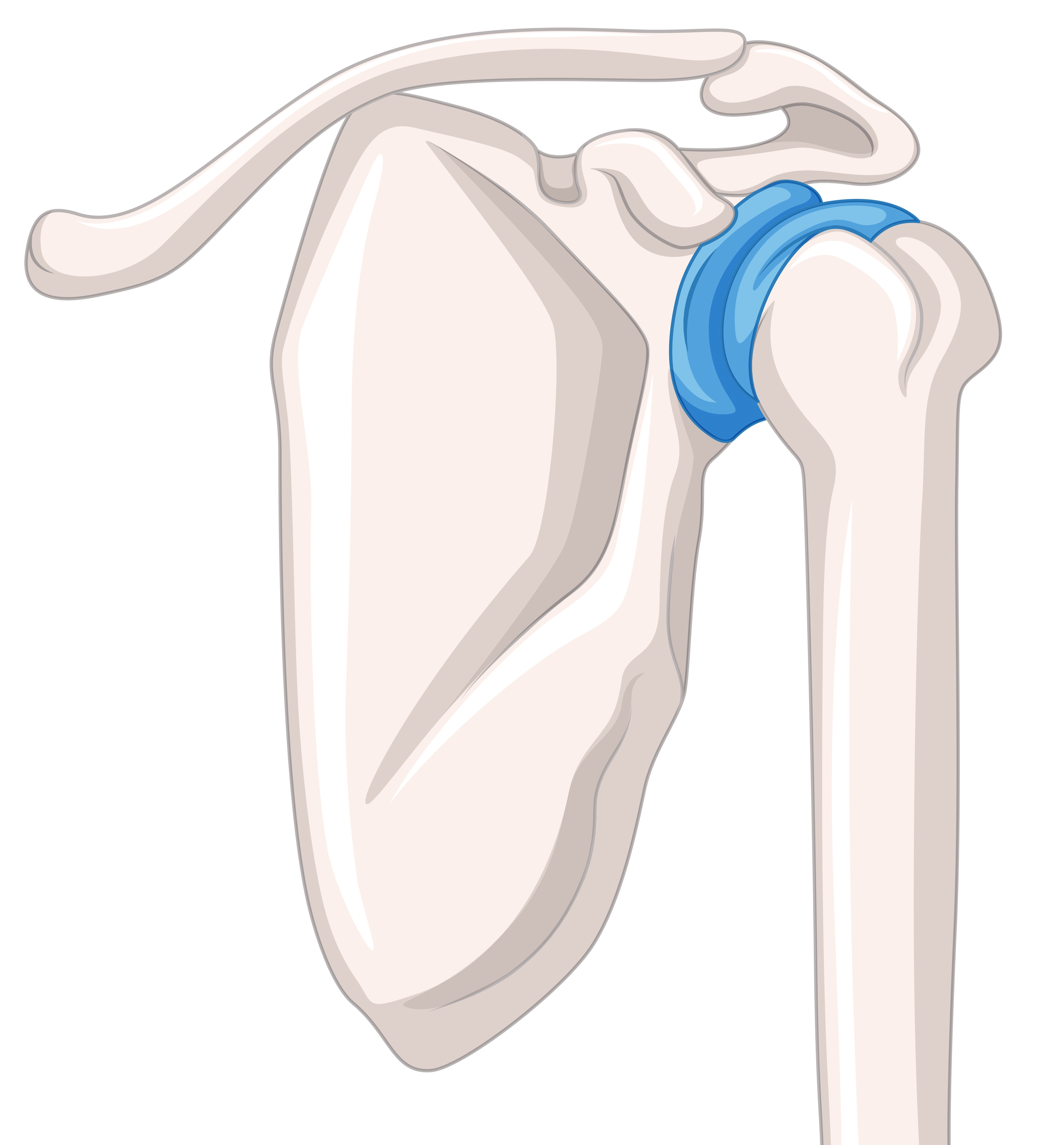 Long Bone Fractures